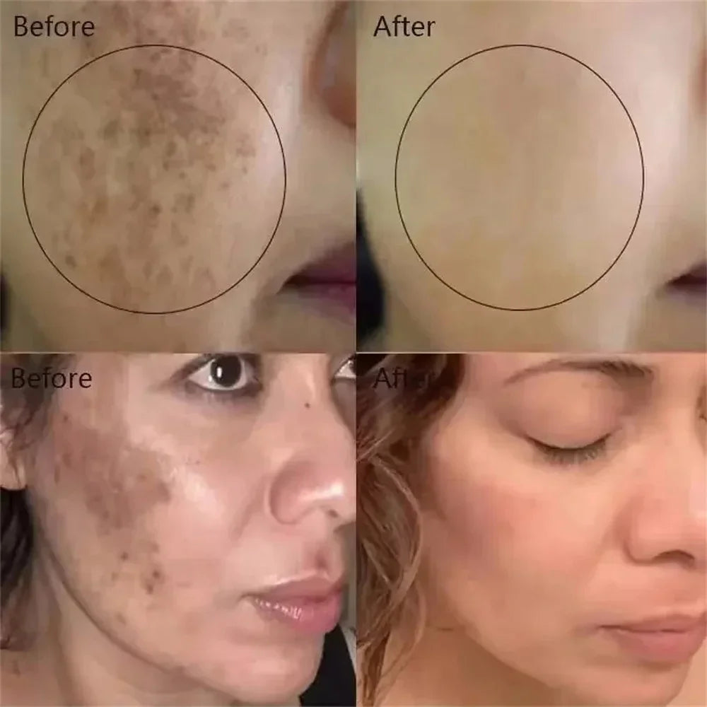Powerful Spot-Removing Whiten Cream Brighten Skin Fast Eliminates Melanin Pigmentation Melasma Dark Spots Korean Face Skin Care